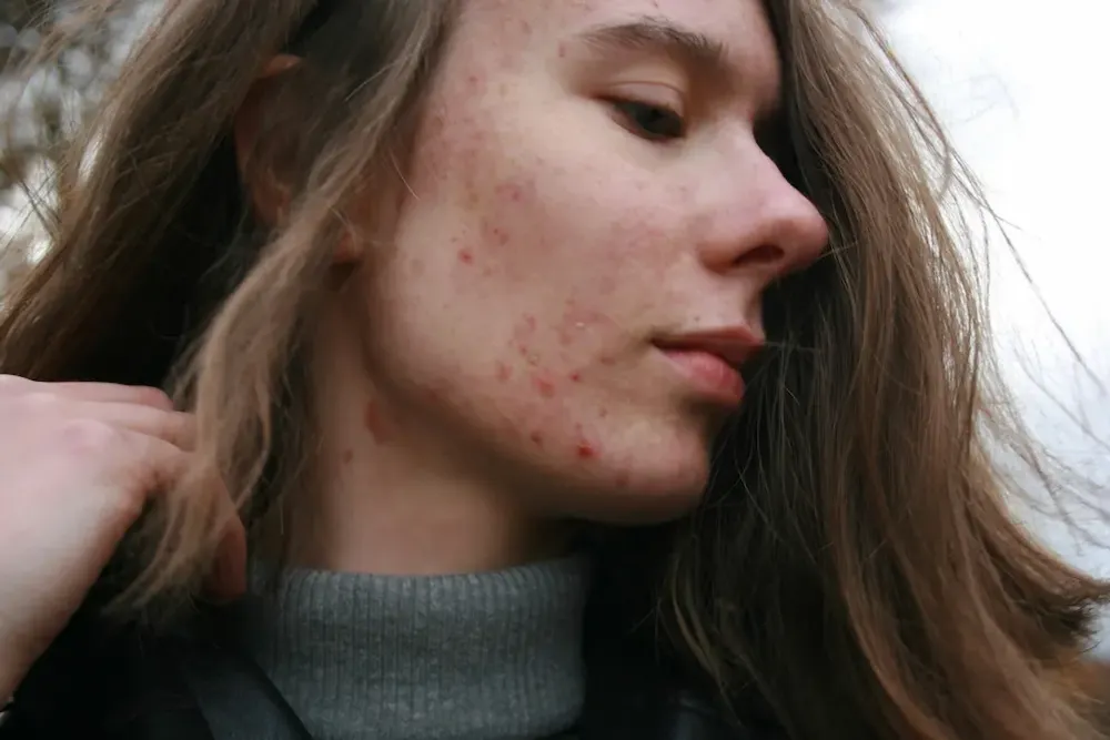 A blonde woman with visible acne receiving a specialized facial treatment for acne-prone skin