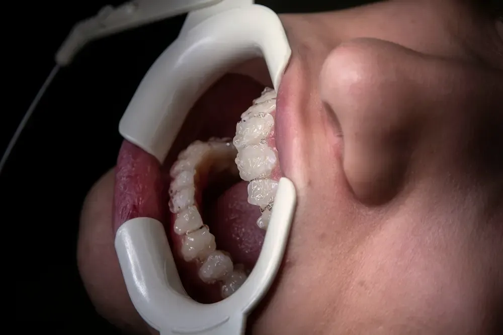Dental mouth retractor holding open a patient's mouth during implant placement surgery, showing osteotomy site preparation.