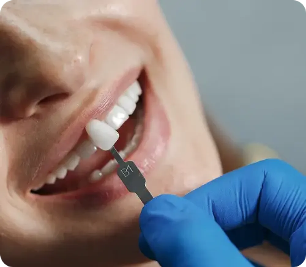 Natural-looking porcelain veneers enhancing a woman's radiant smile with perfect shape and brightness.